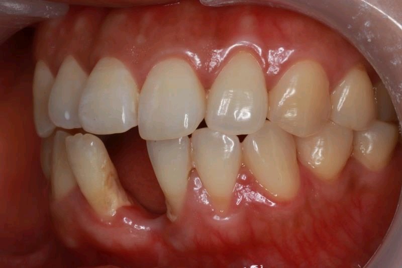 门牙下面这个位置缺了,有点儿影响门面,说话都不敢太_圈子-新氧美容