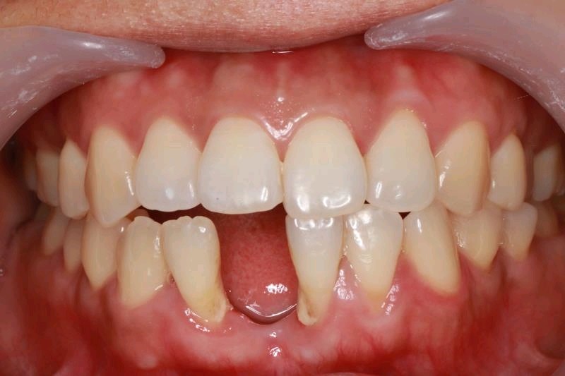 门牙下面这个位置缺了,有点儿影响门面,说话都不敢太_圈子-新氧美容