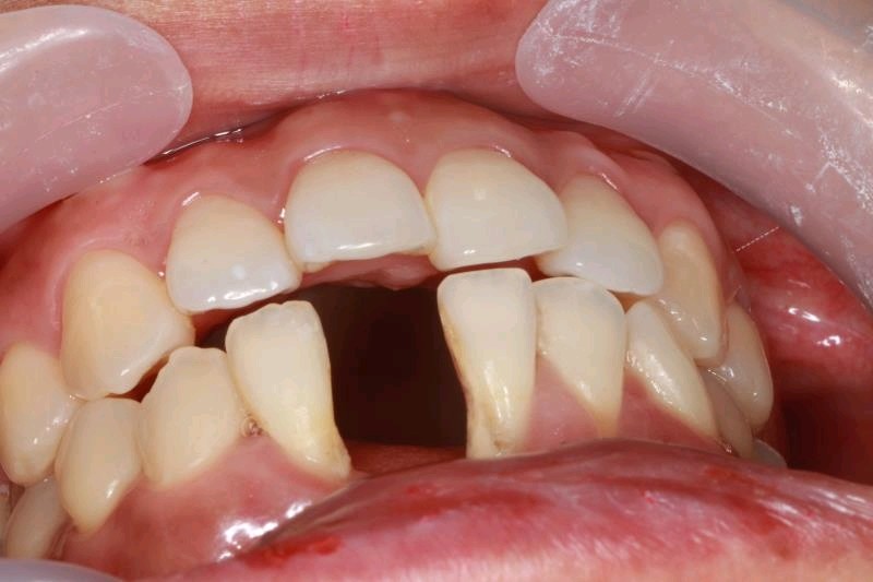 门牙下面这个位置缺了,有点儿影响门面,说话都不敢太_圈子-新氧美容