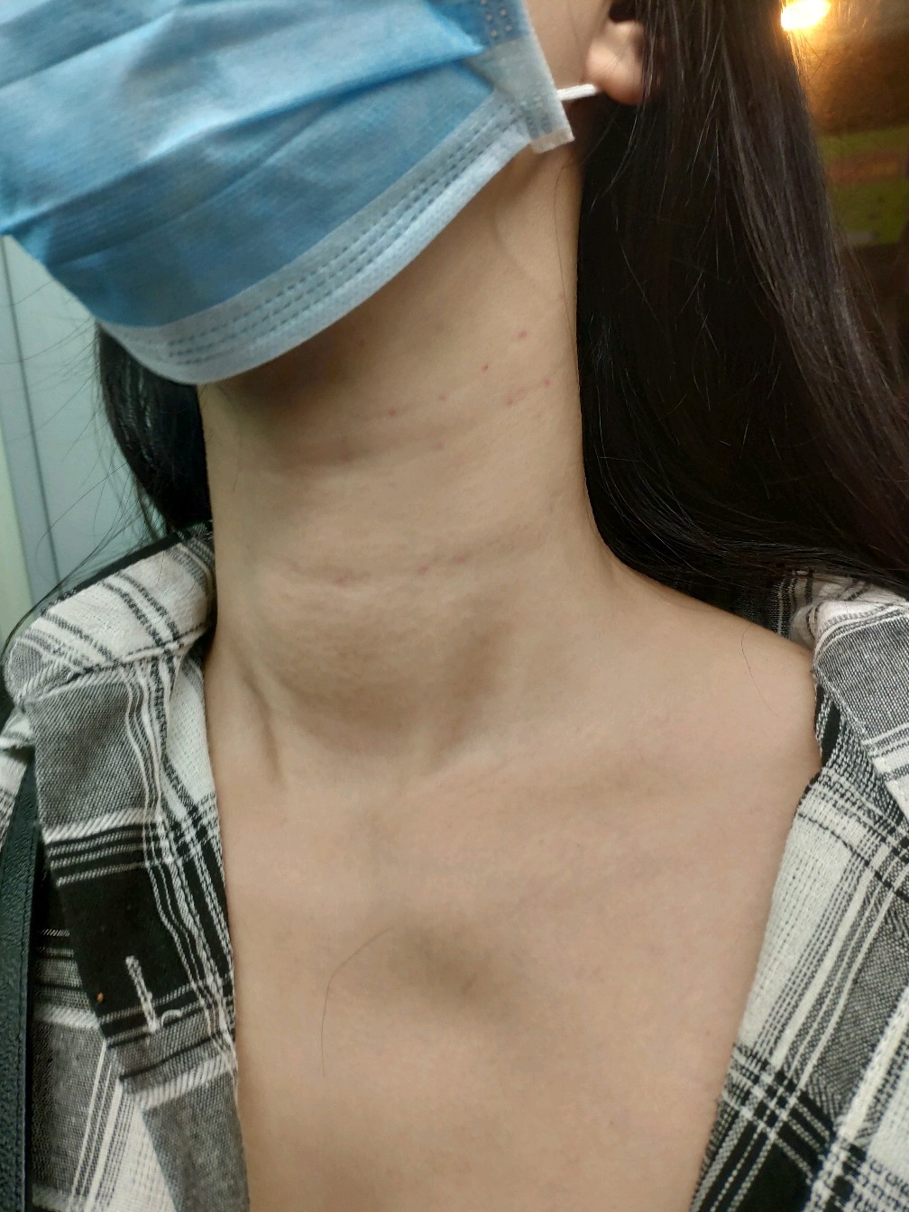 脖子肉堆积颈纹严重图片