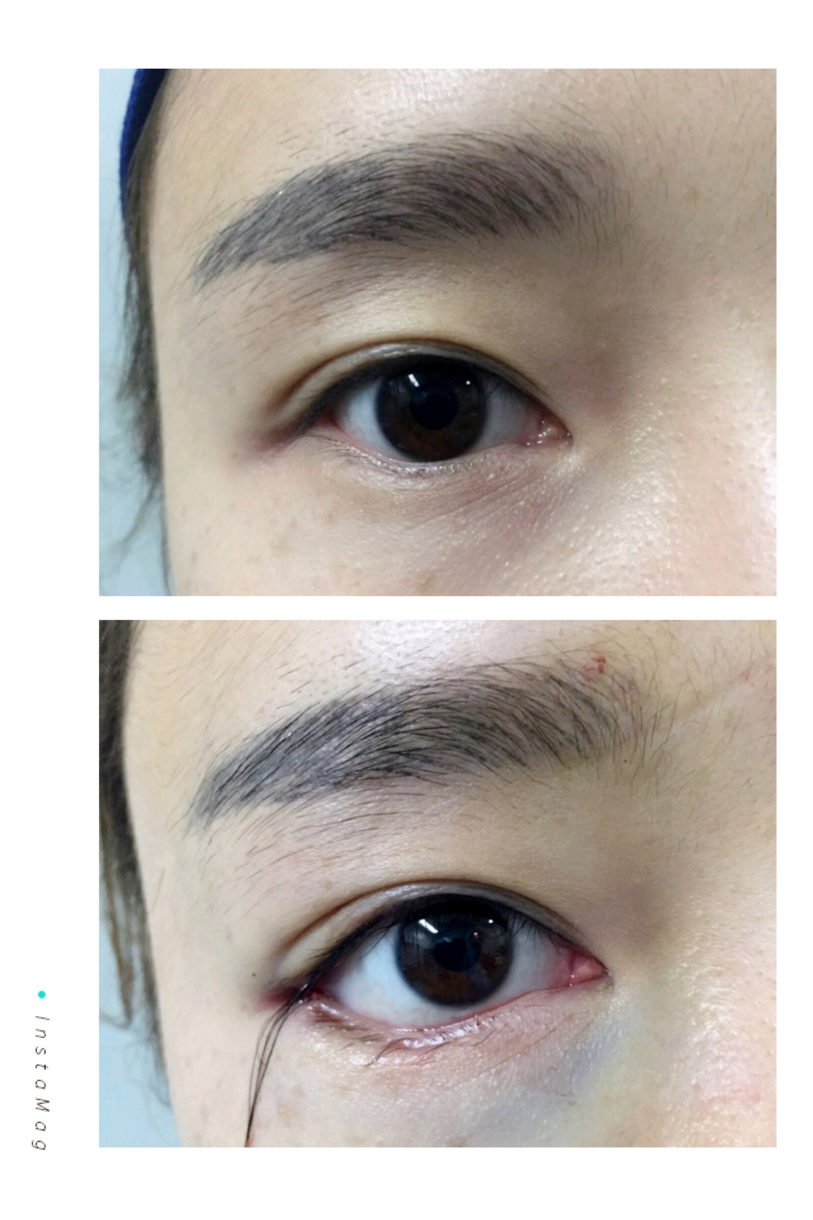 上个月团的下眼睑下至1800,这个月才做的.说实话_圈子-新氧美容整形