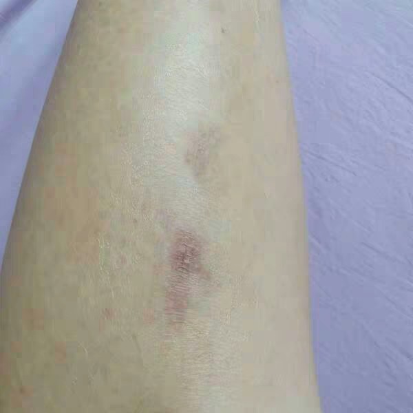 腿上的疤痕是下雨天摔伤的,磕着那边骨头最明显的地方_圈子-新氧美容