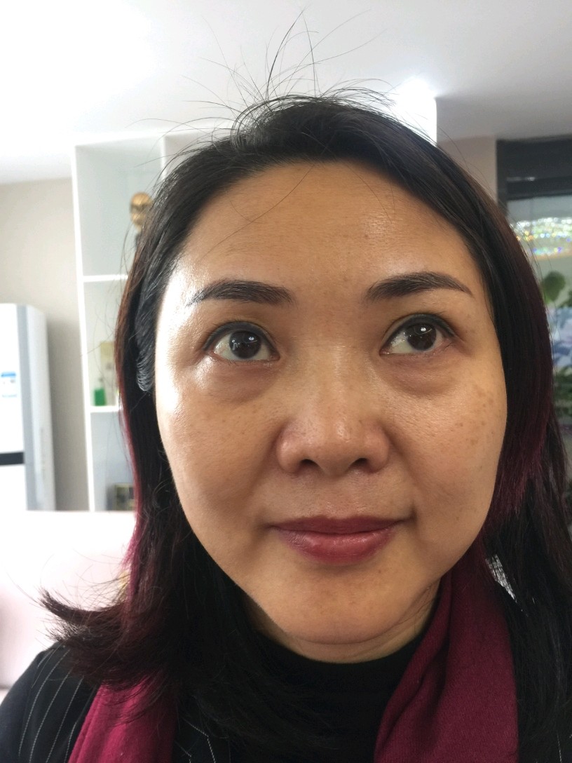 眼袋一凸就显老,去年做的祛眼袋,姐妹伴都说效果很明_圈子-新氧美容