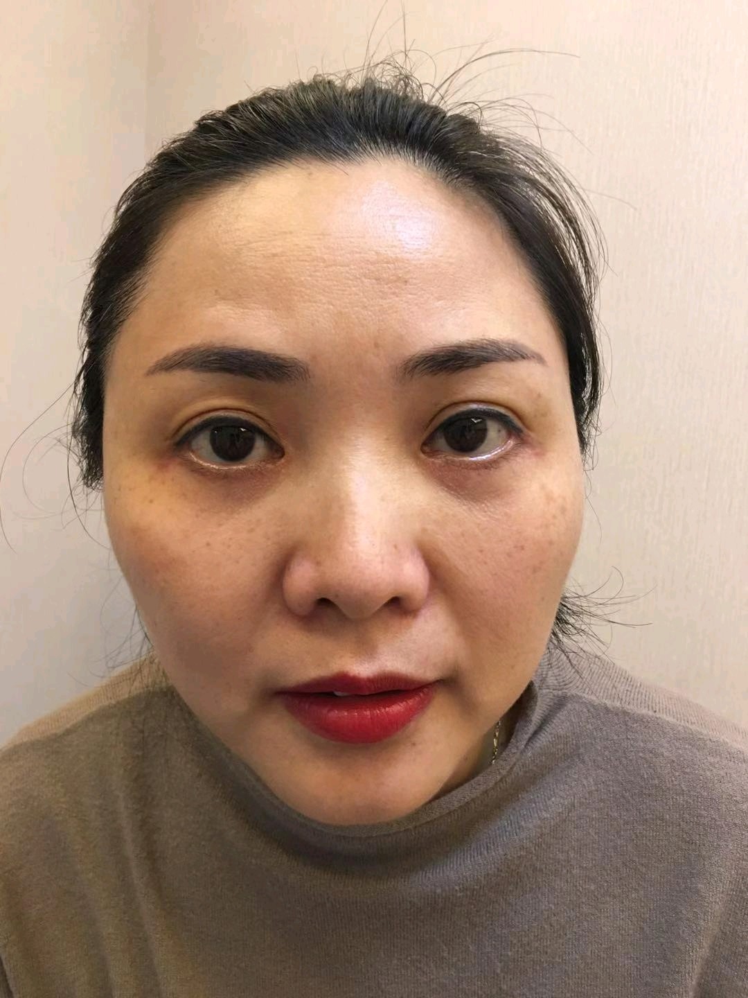 眼袋一凸就显老,去年做的祛眼袋,姐妹伴都说效果很明_圈子-新氧美容