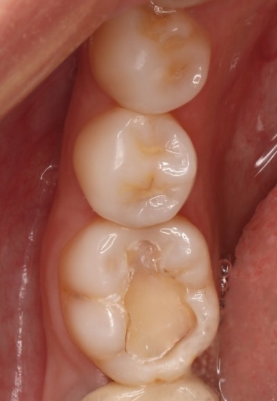 做了根管后补牙.医生做得很好.看不出补的痕迹.