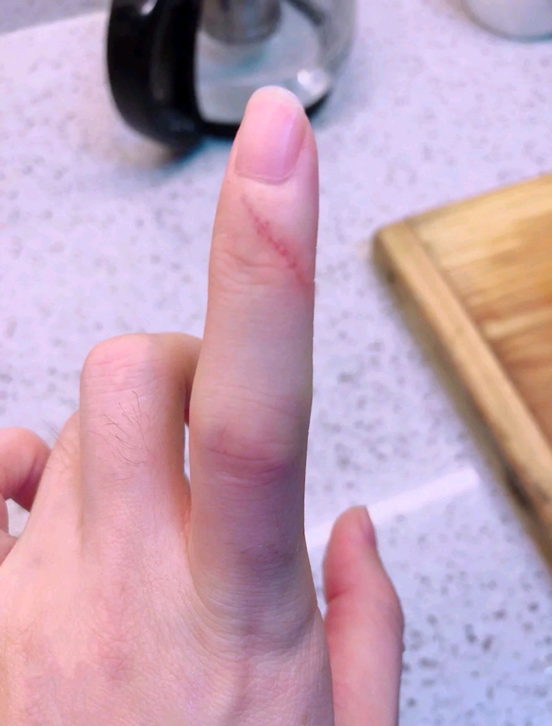 据说很多人的这一跟手指都受过伤,我只是这大多数人中_圈子-新氧美容