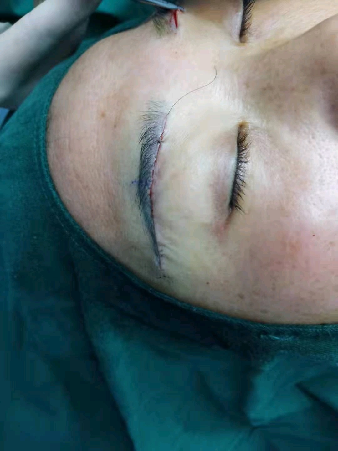跟妈妈一起过来的  医生给我看了术后的照片 伤口