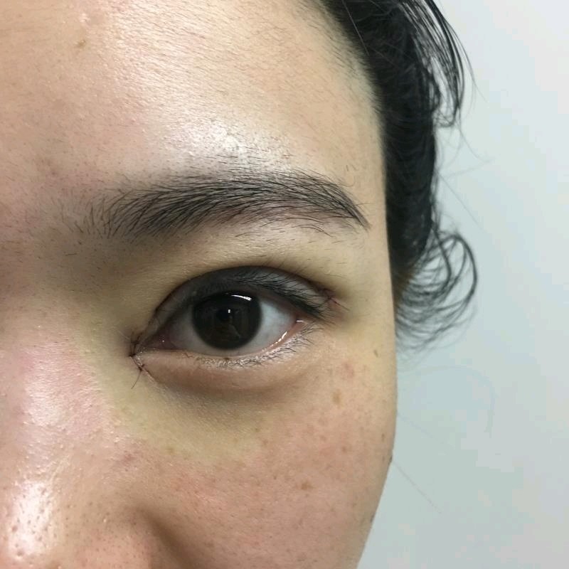 我做的埋线修复,做之前是埋线飘的不行,双眼皮褶皱太_圈子-新氧美容