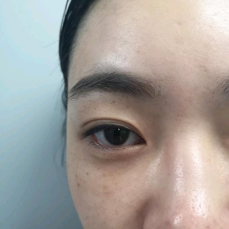 我做的埋线修复,做之前是埋线飘的不行,双眼皮褶皱太_圈子-新氧美容