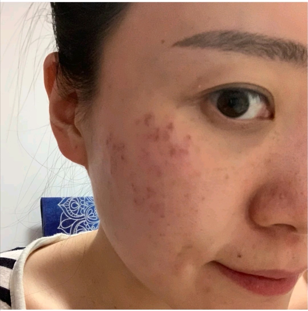 皮秒后斑点加深皮秒治疗前后爆破蜂巢皮秒祛斑深层斑皮秒爆破后的照片