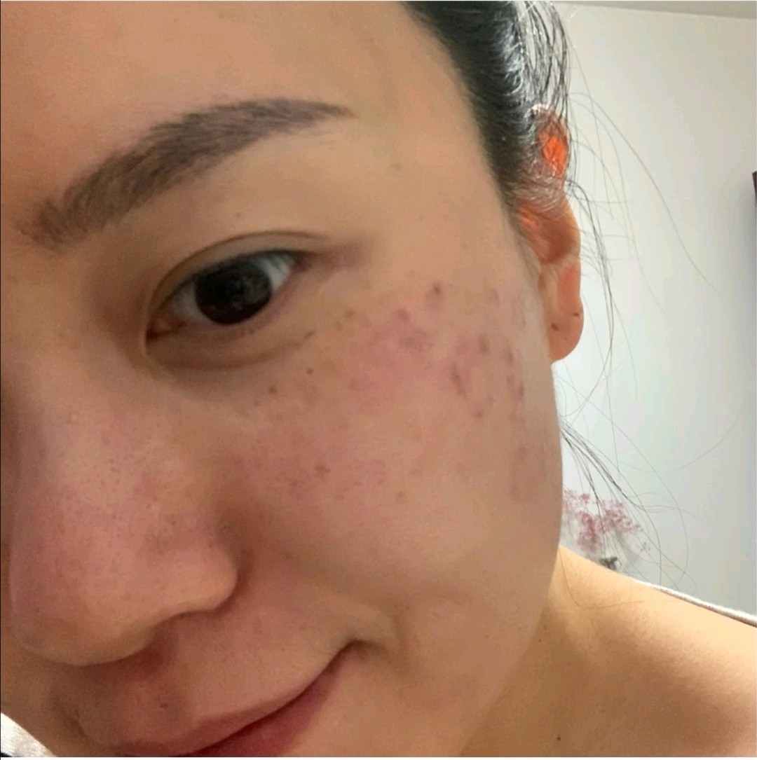 蜂巢皮秒全脸,这家是全程蜂巢透镜的,对斑点做爆破模_圈子-新氧美容