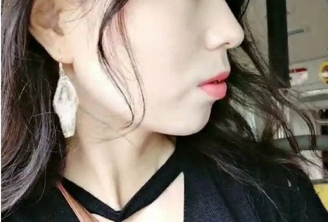 从小牙齿就龅牙,侧面看嘴巴和牙齿都丑,以前怕被说钢_圈子-新氧美容