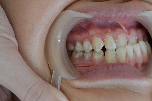 从小地包天,遭受很多人嘲讽,小时候还有人说我牙齿可_圈子-新氧美容