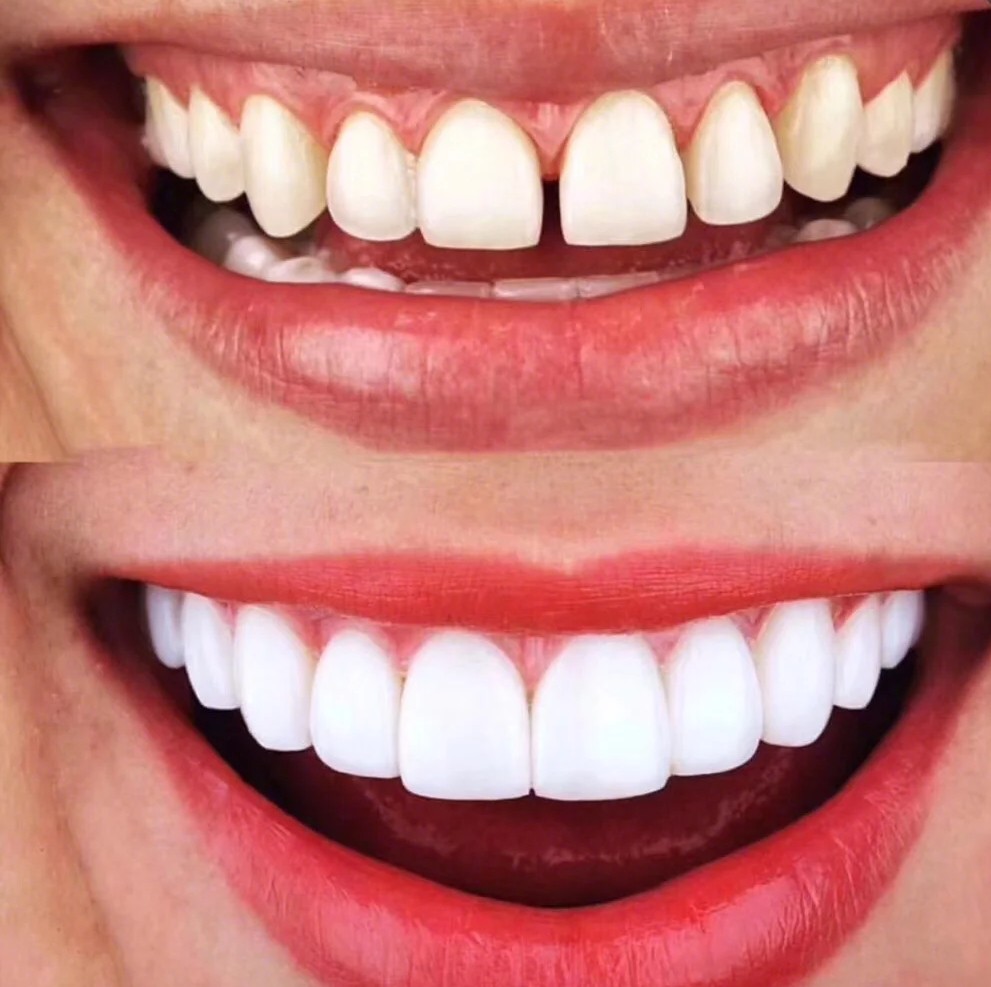 牙齿真的变整齐变白了耶开心做的整个流程下来体验蛮满意的方医生很