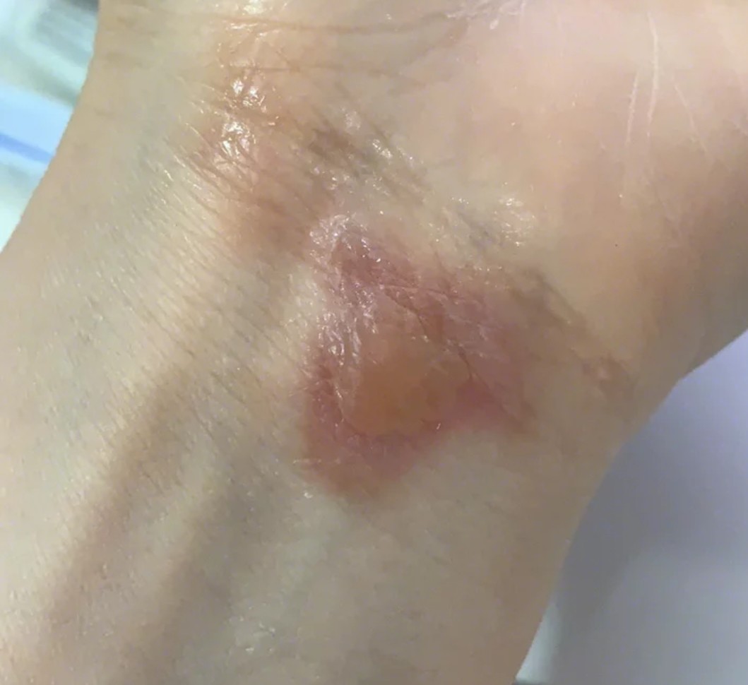 之前被熨斗烫伤了,加上我是容易留色沉的体质吧,伤口_圈子-新氧美容