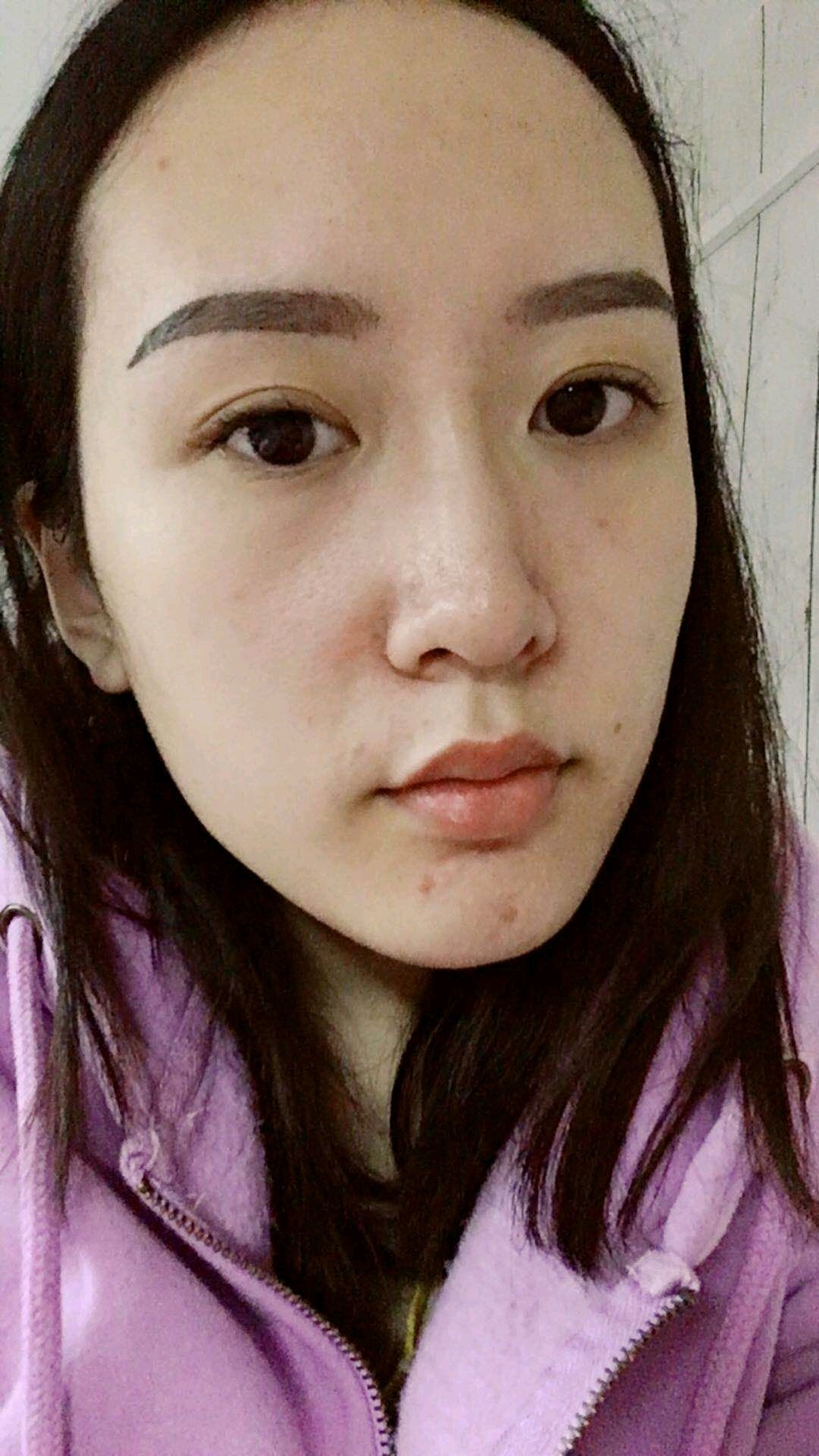 面填之前脸干瘪瘪的,看着一_圈子-新氧美容整形