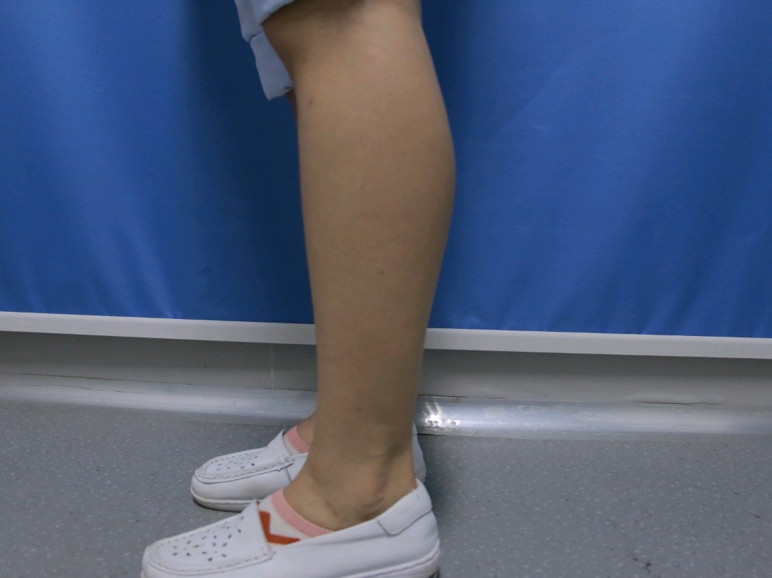 瘦腿针需要打几针_瘦腿针需要稀释吗_针瘦腿打需要注意什么