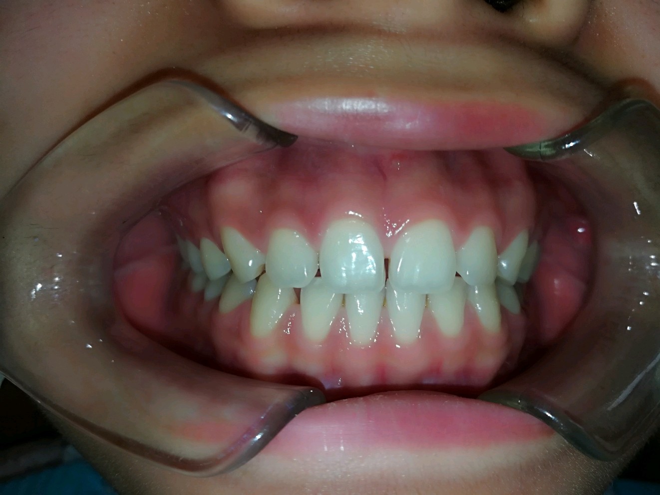 可能小时候吃的钙不多,导致我牙齿生长有点稀疏.