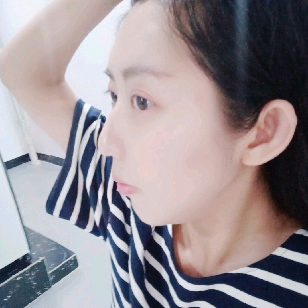 如图所见,我的大塌脑门儿终于饱满了耶开心呢,不过真_圈子-新氧美容