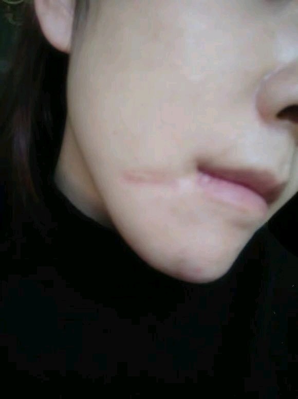 女孩子脸上有块疤是很不幸的事情.