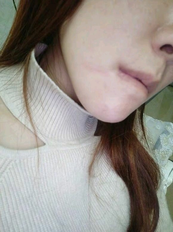 女孩子脸上有块疤是很不幸的事情.