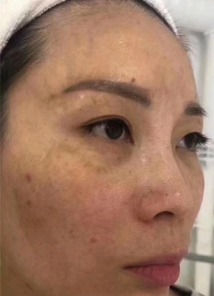 【小棕瓶美白】英诺小棕瓶祛斑美白注射对色沉,祛痘