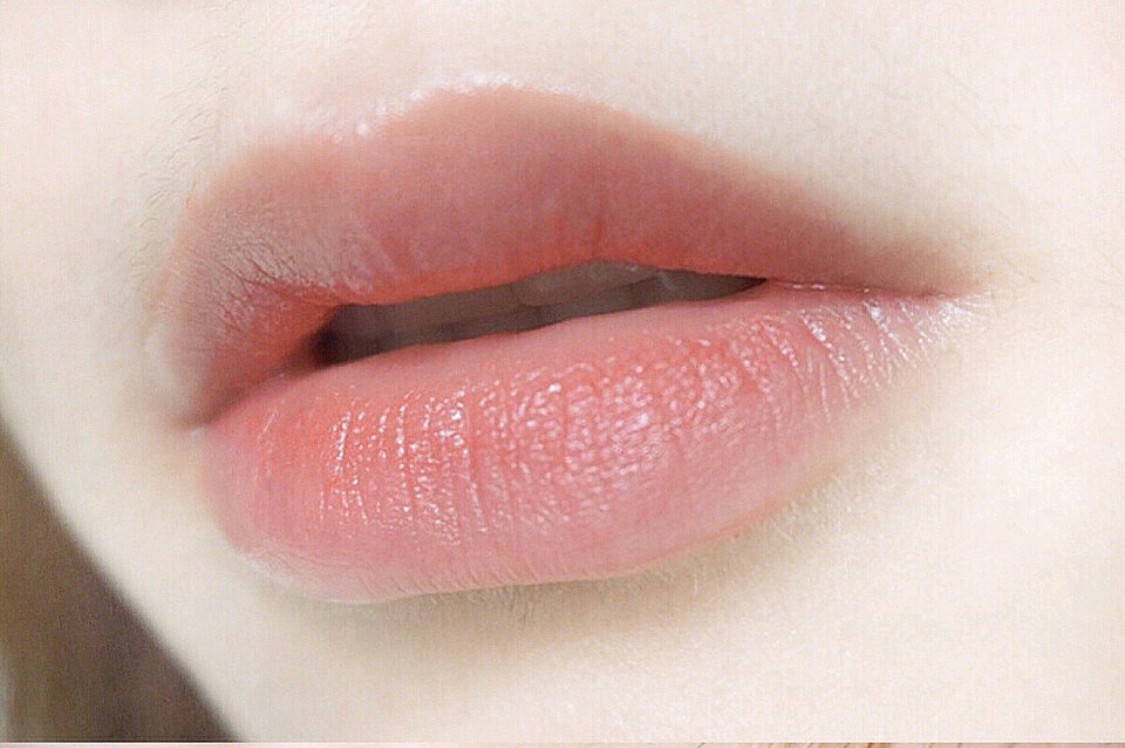 【m唇手术】主任亲诊 m花瓣唇/嘟嘟唇/微笑唇清纯性感青春驾驭,元气