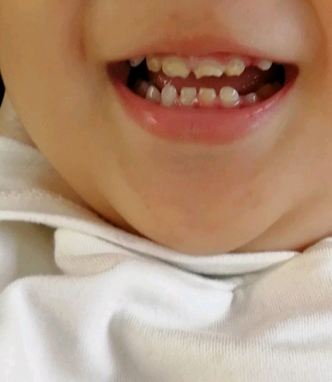 三岁宝前门牙奶瓶齿图片