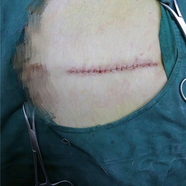 肚子上剖腹产的疤痕已经和其他正常皮肤没有什么区_圈子-新氧美容整形