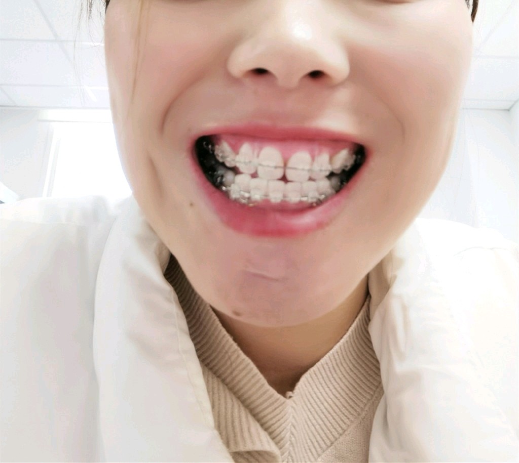 我的牙中线不齐,整体往右边偏了半个门牙的位置,笑的_圈子-新氧美容