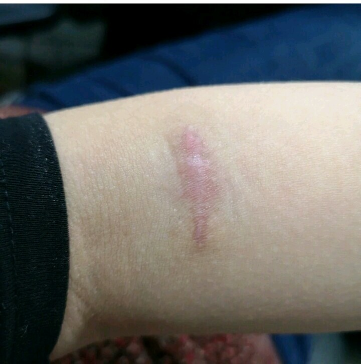 手术效果很好,解决了我多年的疤痕问题,现在胳膊上的_圈子-新氧美容