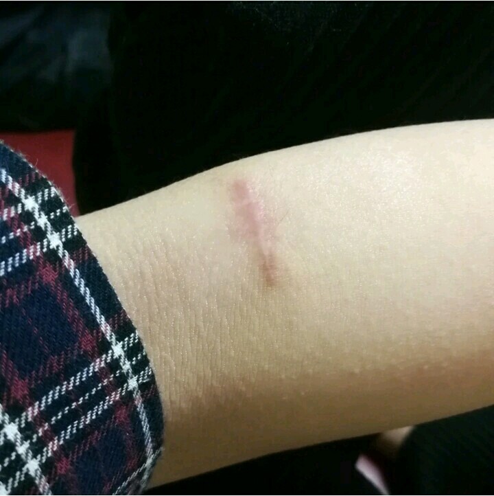 手术效果很好,解决了我多年的疤痕问题,现在胳膊上的