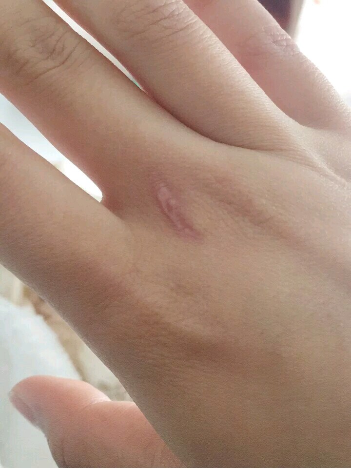手上的刀疤图片