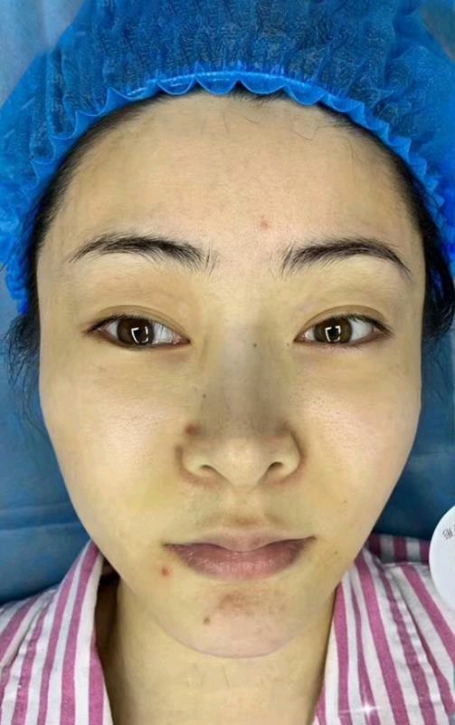 脸部松垮这不是我能接受的,线雕的效果