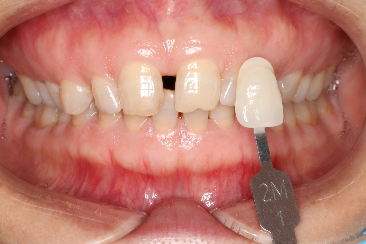 都说牙缝大漏财,我这个牙缝这么大,不仅漏财还很丑,_圈子-新氧美容