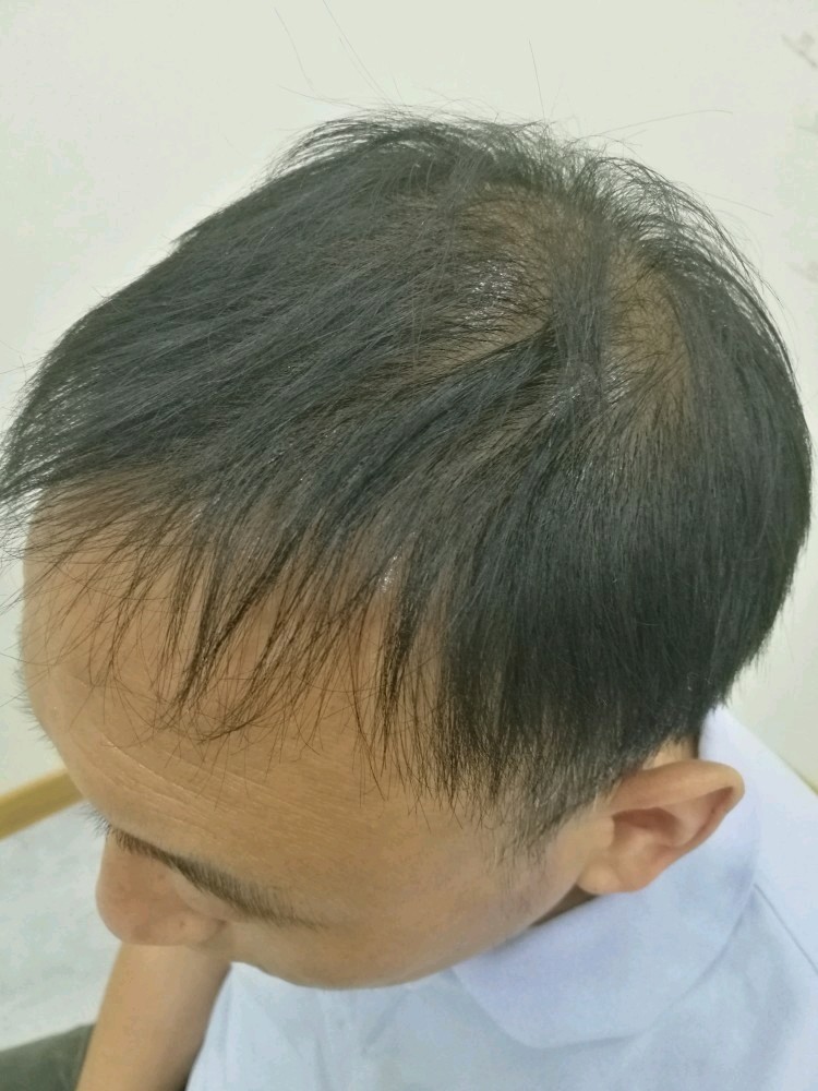 本人脱发严重头顶稀疏很大发际线在经过多家对比之后选择在青岛洋美