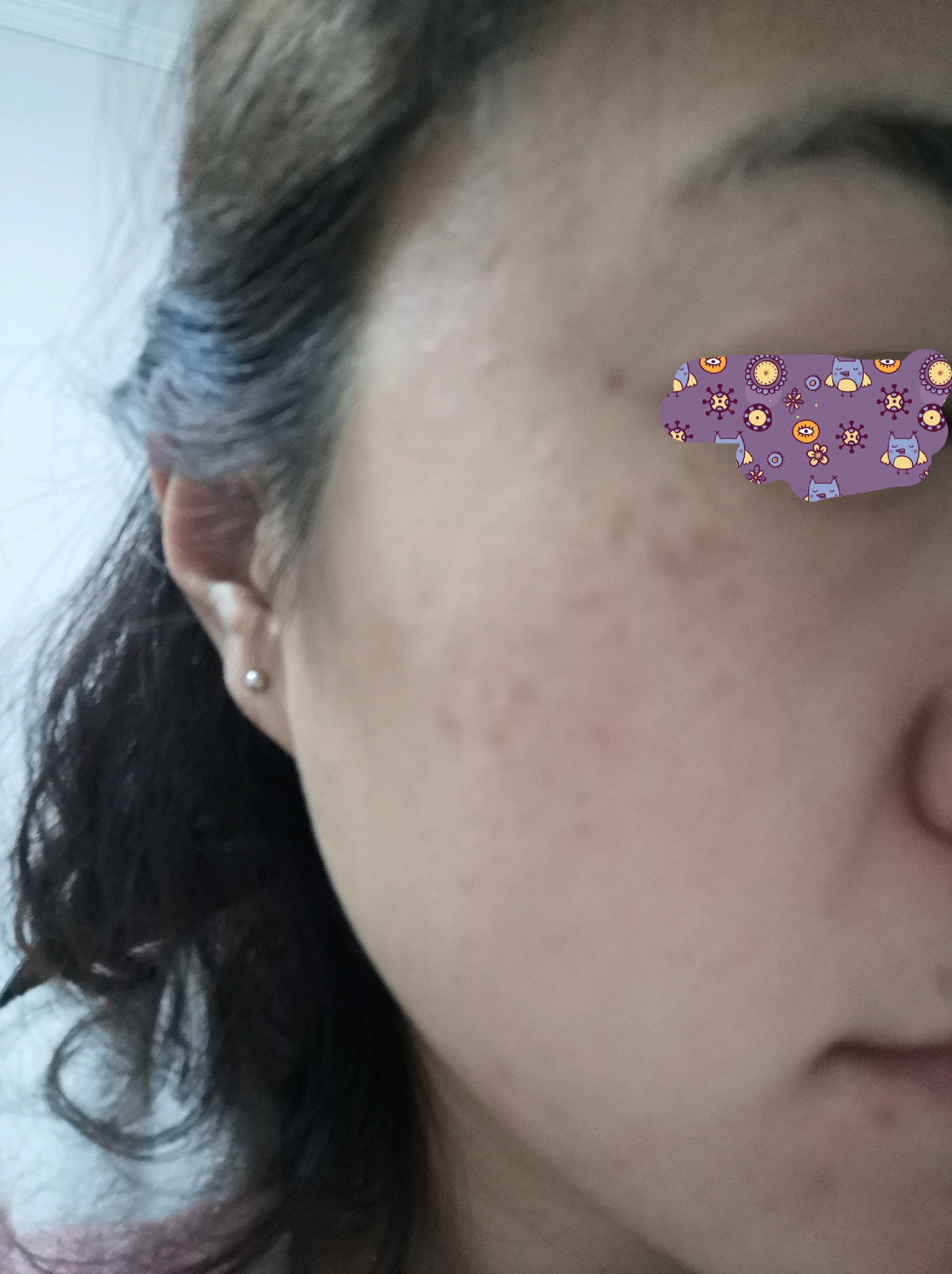 医生说我是褐青斑,需要多次治疗.