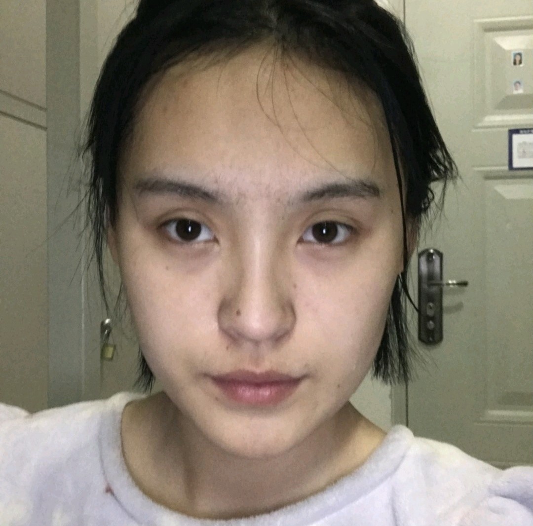 以前鼻子很大,又塌,奈何自己硬件跟不上,就算技术再_圈子-新氧美容