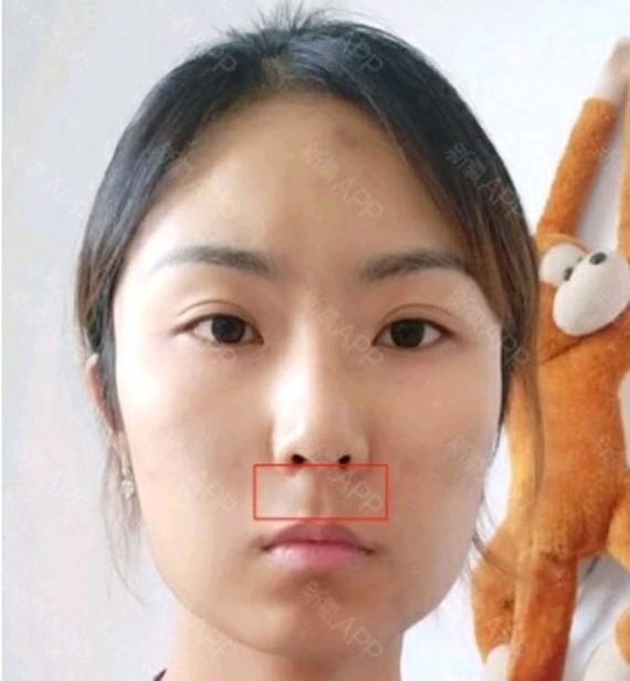 说完人中接下来需要改善的就是你面颊凹陷的问题,面颊凹陷可选择自体