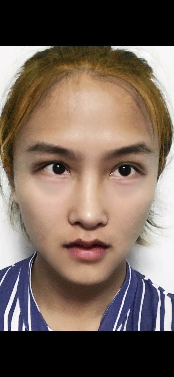 优点939393底子好,骨骼流畅,眉骨优秀,双眼皮恢_圈子-新氧美容