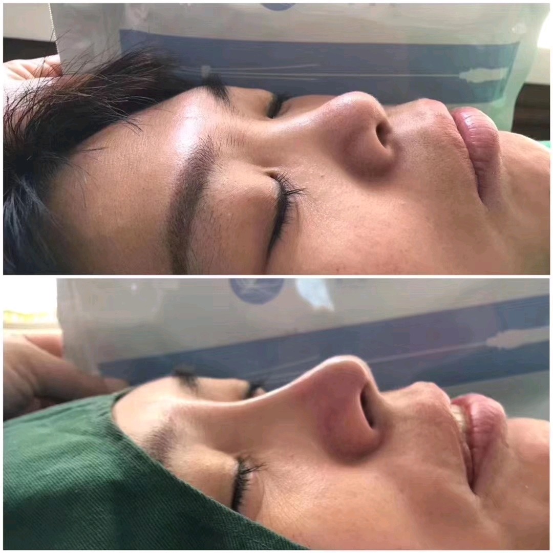 葡聚糖填充,术后堪比肋骨鼻.