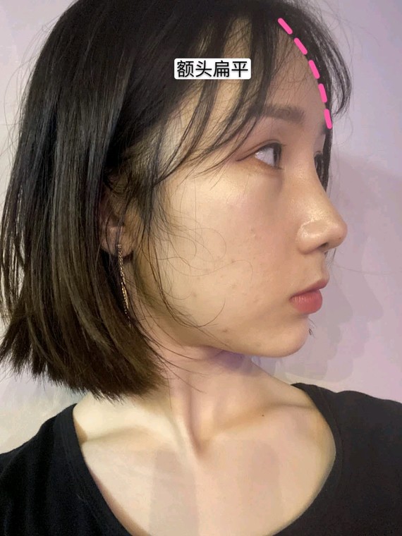 伴随脸部会有轻微的凹陷,同时苹果肌也比较扁平,侧脸看额头也不够饱满
