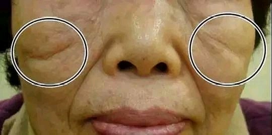 "印第安纹"又称颧颊沟,指的是颧骨下侧因颧骨韧带及_圈子-新氧美容