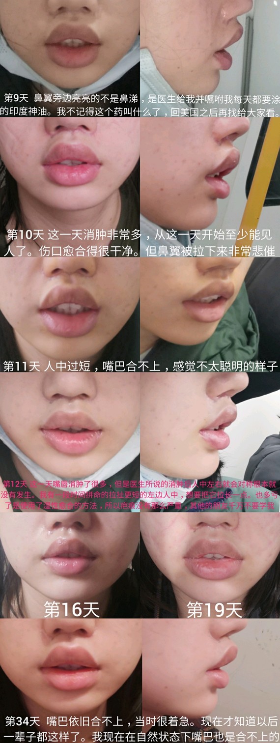 我为什么选择了在美国做人中缩短?