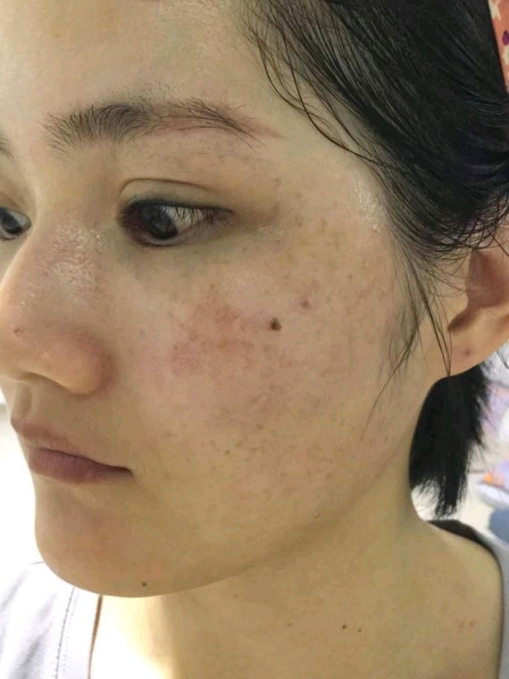 雀斑晒斑黄褐斑红血丝应该先做哪个好