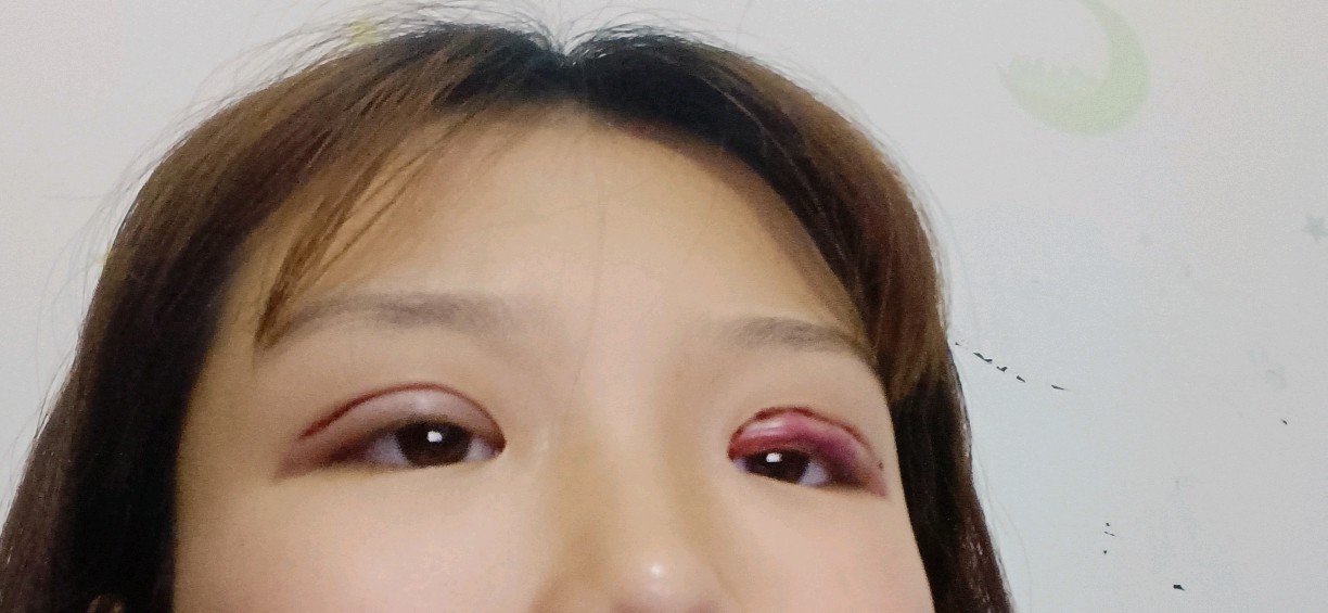 埋线双眼皮第五天这种情况正常吗