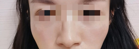 我感觉我鼻头有点鹰钩,不够精致,我想问一下我鼻子需要怎么整