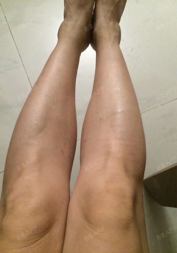 我的小腿肌肉太发达了必须打第二次