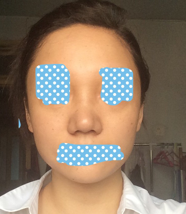 已经过去一个半月了,理性分析,鼻尖依然比较突出,自己每天应该做的