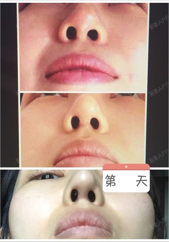 这鼻头快成格格巫了